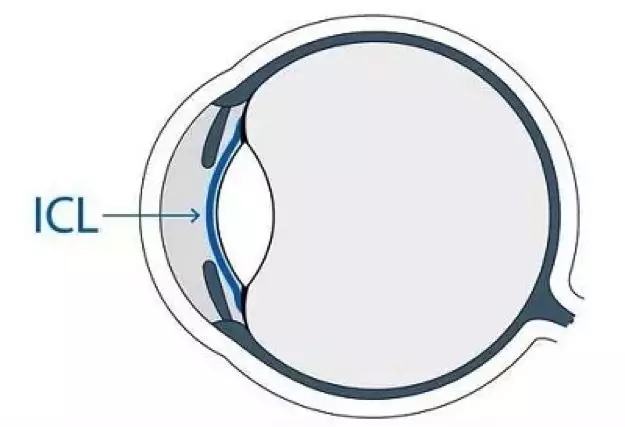 昆明ICL晶体植入术费用