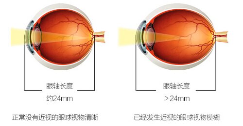 高度近视“终结者”：ICL（V4c）晶体植入术